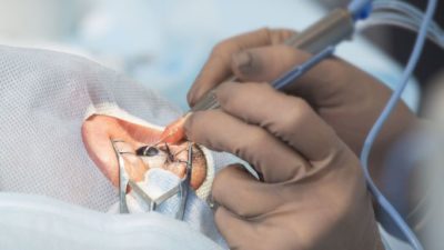 Surgical Lasers Market