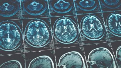 Neurological Disorder Diagnostics Market