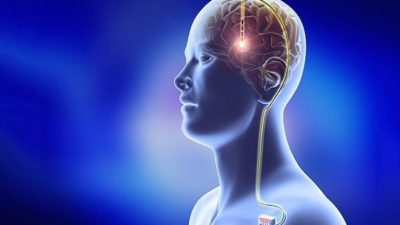 Deep Brain Stimulation in Parkinson’s Disease Market