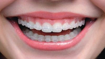 Orthodontic, Invisible Orthodontic and Lingual Orthodontic Market