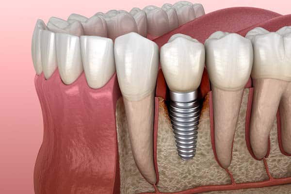 Global Peri Implantitis Market Opportunities, Trends, And Growth To 2029