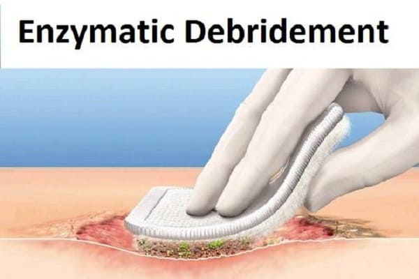 enzymatic-debridement-market-global-industry-research-report-by-2030