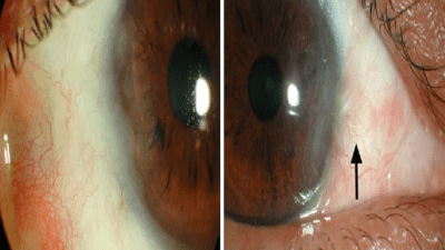 Ophthalmic Mitomycin C Market